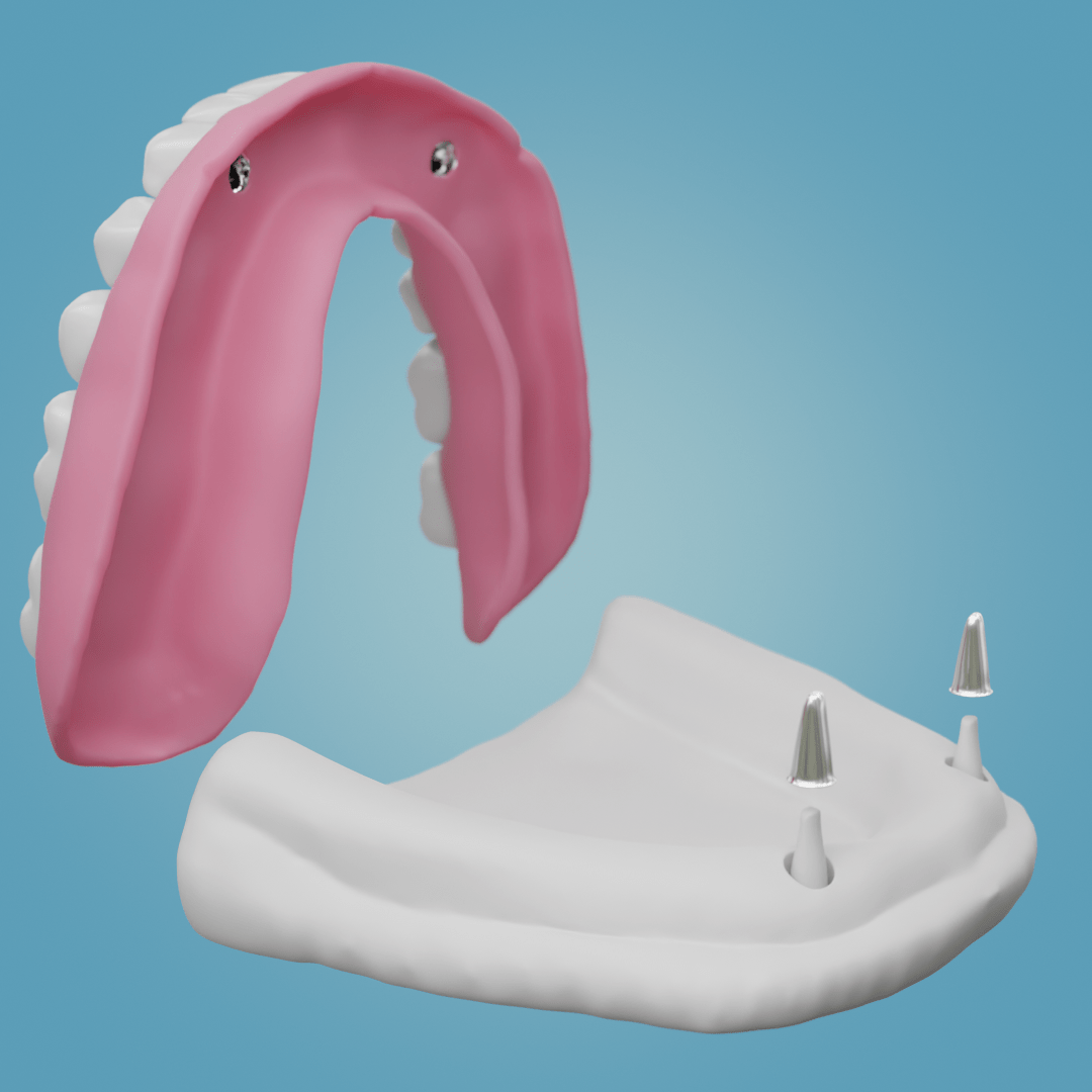 Read more about the article Coverdenture